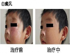 白癜风的危害，会引起自杀吗？